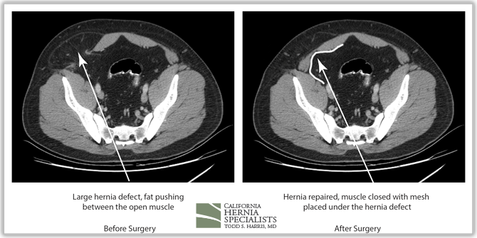 Spigelian Hernia post surgery CT scan image compared with pre surgery